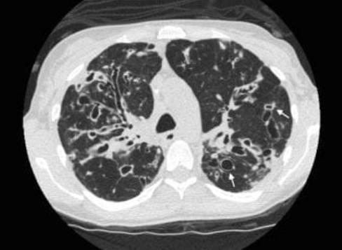 Рисунок 4: КТ ОГП – двусторонние бронхоэктазы в легких 