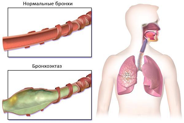 Рисунок 2: 1-нормальные бронхи, 2- бронхоэктазы. 
