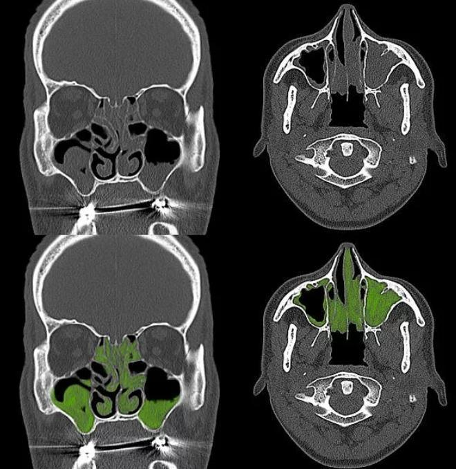 Рисунок: КТ пазух носа при синусите