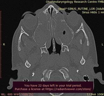 Рисунок: КТ пазух носа двустороннее поражение пазух (что характерно при ПЦД)